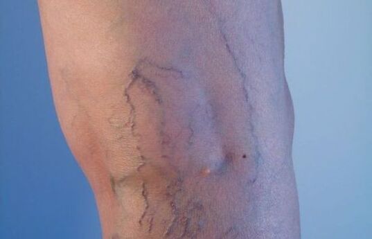 Krampfadern in den Beinen bei Frauen