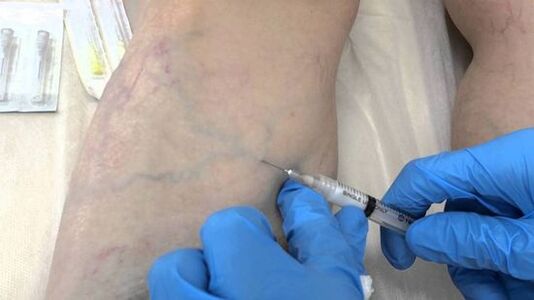 Sklerotherapie bei Krampfadern in den Beinen bei Frauen