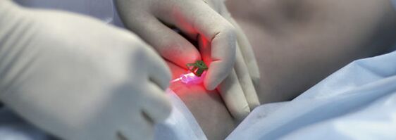 Entfernung einer Beinvene mittels Laserkoagulation.